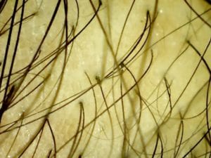 male pattern baldness