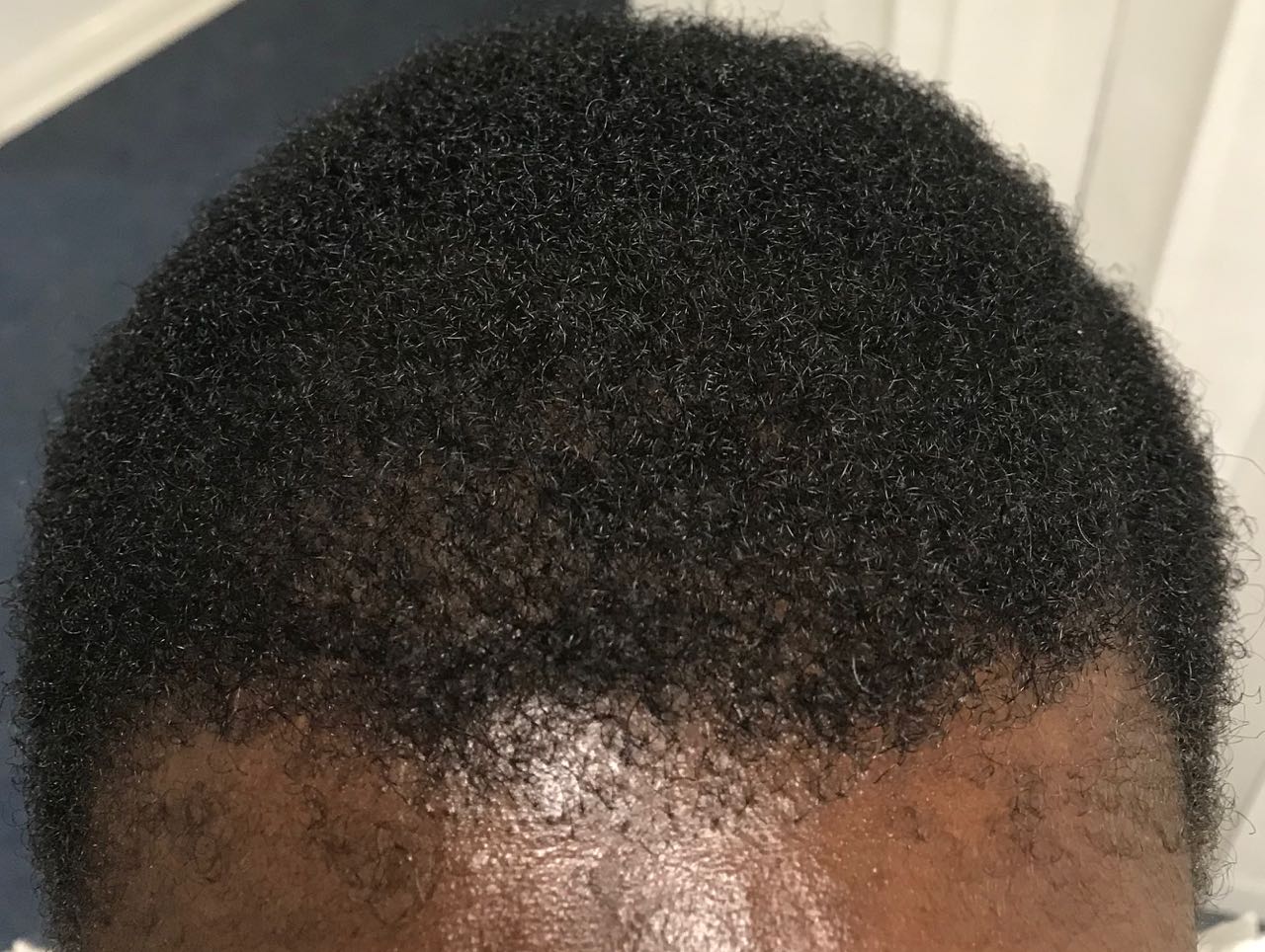 Afro Hair Loss & Treatment Holborn Hair Scalp Clinic