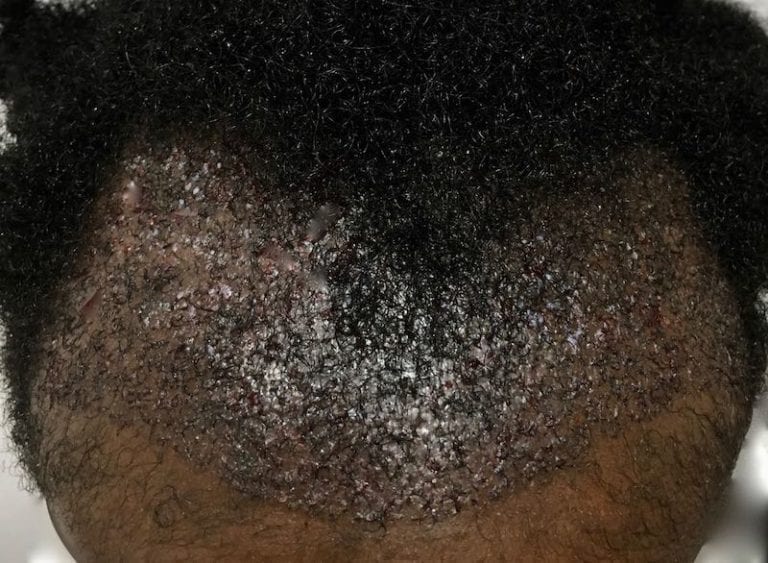 Afro Hair Transplant | Holborn Hair Scalp Clinic | Price from £2000