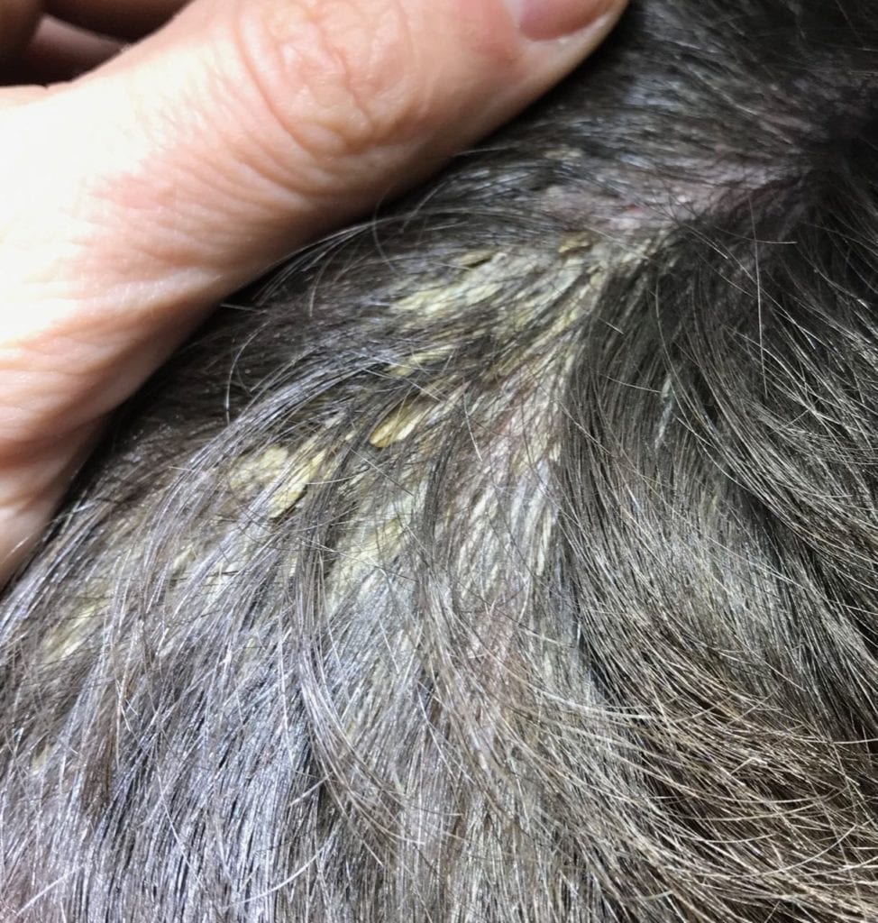 Scalp Psoriasis | Itchy Scalp | Dry Scalp | Scalp Crusting