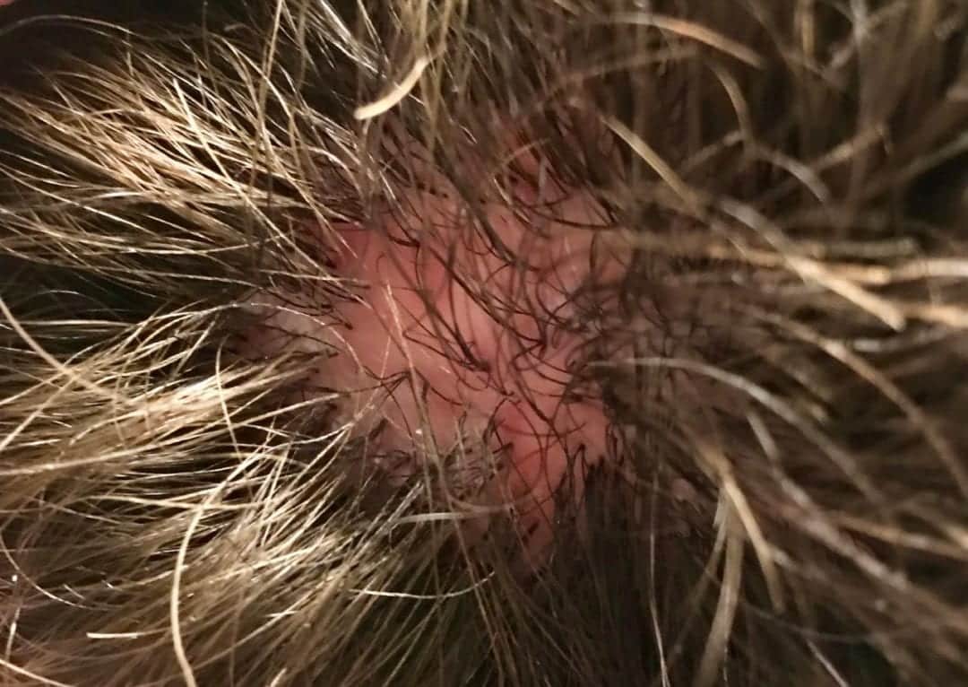 Scarring Alopecia, Advice and Treatment Avoid Antibiotics