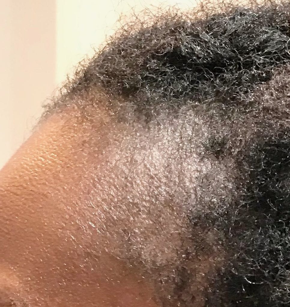 Afro Hair Transplant | Holborn Hair Scalp Clinic | Price from £2000