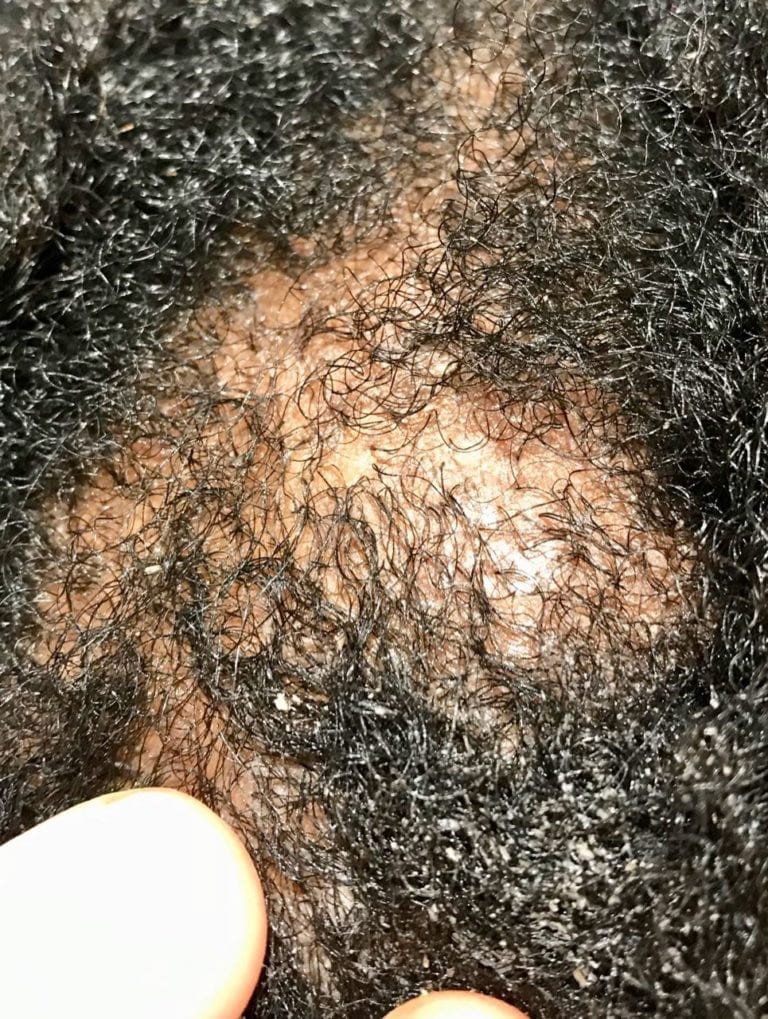 Afro Scalp Cleansing Remove The Itchy Dry Flaky Scalp 