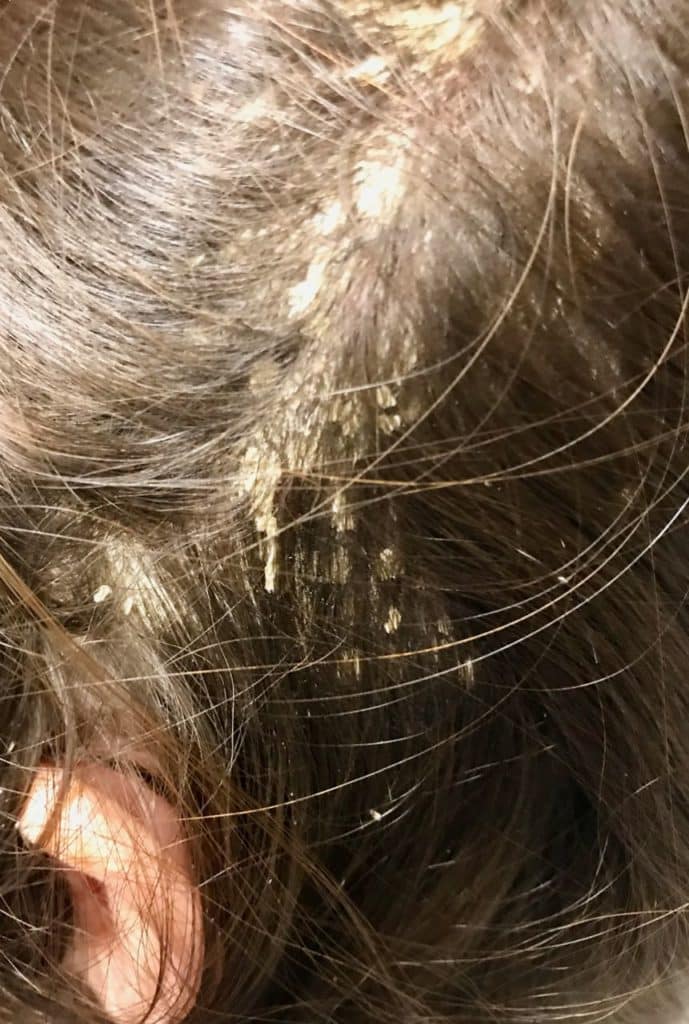 Scalp Psoriasis | Itchy Scalp | Dry Scalp | Scalp Crusting