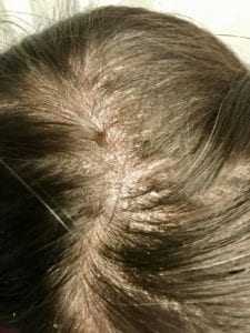 Scalp Psoriasis | Itchy Scalp | Dry Scalp | Scalp Crusting